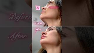 👄 Lips amp Chin Augmentation Enhance Your Natural Beauty [upl. by Kuhlman]