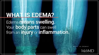 What is Edema  WebMD [upl. by Liuka]