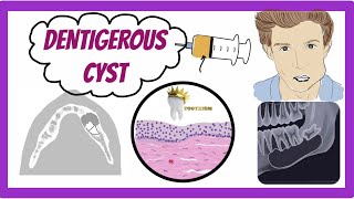 ORAL PATHOLOGY  DENTIGEROUS CYST [upl. by Eniar]