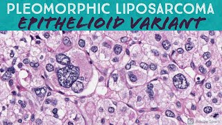 Pleomorphic Liposarcoma Epithelioid Variant [upl. by Perle]