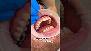 Composite bonding does damage my teeth Smile smilemakeover [upl. by Ahserb]