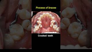 Crooked teeth braces process braces orthodontist dentist crookedteeth [upl. by Tunk]