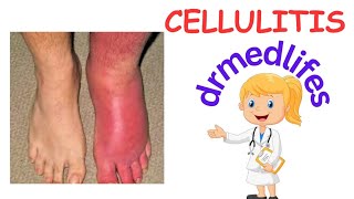 cellulitis  causes clinical features  investigation treatment [upl. by Letniuq711]