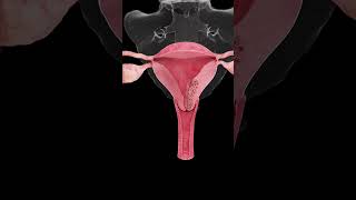 🎗️ Understanding Endometrial Cancer A Growing Concern for Women’s Health 🎗️ [upl. by Eneliak]