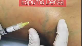 Tratamento de Varizes com Espuma Densa [upl. by Nonez]