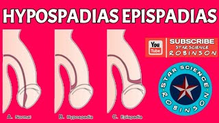 HYPOSPADIAS EPISPADIAS IN STAR SCIENCE ROBINSON [upl. by Sila]