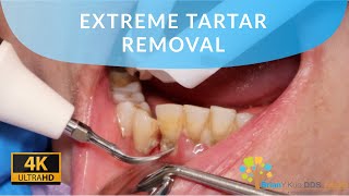 EXTREME TARTAR REMOVAL satisfying dental dentist [upl. by Kelton]