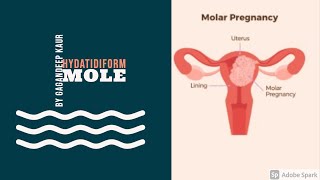 HYDATIDIFORM MOLE Unit7 OBG HIGH RISK PREGNANCY [upl. by Kirsten573]