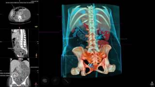 Sectra Table Case Study Kidney Transplant [upl. by Doria]