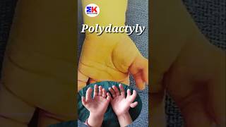 Polydactyly  What is Polydactyly shorts MedicineKnowledgehindi [upl. by Liagabba904]