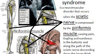 Noninvasive cure of the piriformis syndrome by PNF Copyrights reserved [upl. by Lyrahs]