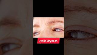 ಕಣ್ಣಿನ ರೆಪ್ಪಯ ಒಣಗುವಿಕೆಗೆ ಉತ್ತಮ ಪರಿಹಾರ eyelid dryness and eye bags remedy [upl. by Zeus146]