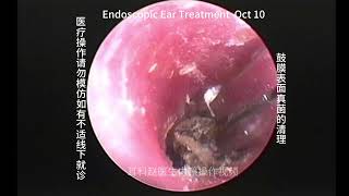 Fungal cleaning on the surface of the tympanic membrane [upl. by Nye]