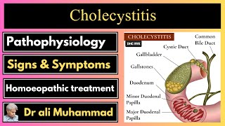 Cholecystitis amp homeopathy Dr Ali Muhammad [upl. by Revilo]