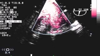 Spontaneous echo contrast SEC in the left atrial appendage [upl. by Tonry381]