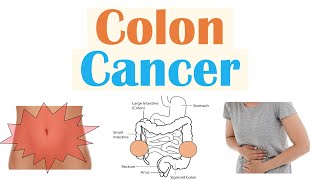 Colon Cancer CRC Risk Factors Pathogenesis Symptoms Diagnosis Staging Treatment [upl. by Careaga]