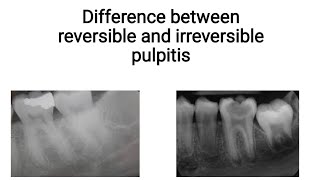 difference between reversible and irreversible pulpitis [upl. by Chandless716]