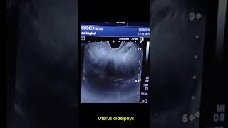 Uterus didelphys with right adnexal haemorrhage cyst [upl. by Nebra76]