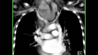 Cardiac Persistent left superior vena cava emptying into coronary sinus 4 of 4 [upl. by Ute]