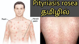 Pityriasis rosea explanation in tamilmedical awareness in tamil [upl. by Kassity842]