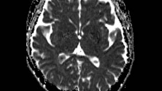 Choroid Plexus Xanthogranuloma [upl. by Richardo192]