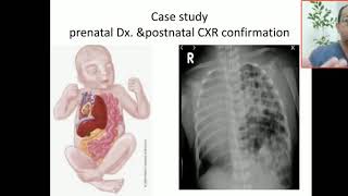 Case 47 congenital diaphragmtic hernia bochdalek hernia morgagni hernia [upl. by Trixi362]