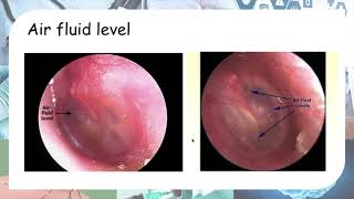 Acute otitis media  Otoscopy findings [upl. by Tullusus]