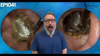 The Most Shocking Ear Wax Removal Youve Never Seen  EP1041 [upl. by Aihsinat]