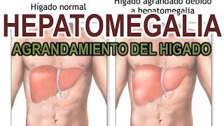 HEPATOMEGALIA  AGRANDAMIENTO DEL HIGADO [upl. by Odraccir858]