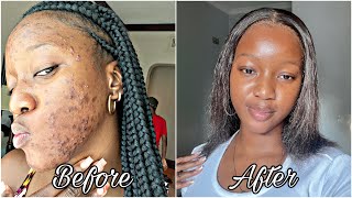 How I finally cleared my acne prone skin  Skin care routine🧴with photo evidence [upl. by Rouvin]