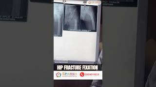 Hip fracture fixation intertrochantericfracture [upl. by Yerhpmuh949]