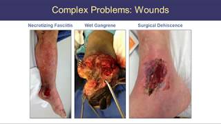 Negative Pressure Wound Therapy with Instillation Interdisciplinary Panel Recommendations [upl. by Grindlay]