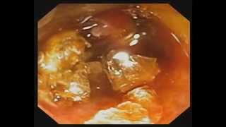 Direct Peroral Cholangioscopy with Electrohydraulic Lithotripsy for Cystic Duct Stone [upl. by Ayra]