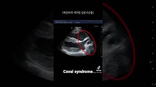 caval syndrome removal hw [upl. by Mortie984]