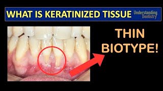 Gingival Recession Treatment How to Check the Keratinized Gingival Tissue Periodontal Maintenance [upl. by Modesta]