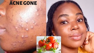 GET RID OF ACNE IN 5 DAYS WITH TOMATOES FACE MASKSHOCKING RESULT tomatoesfacemask acnetreatment [upl. by Gare727]