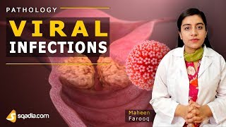 Viral Infections  Mumps  Pathology Video Lectures  Medical VLearning  sqadiacom [upl. by Vescuso]