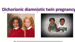 Anatomy of dichorionic and diamniotic twin pregnancy with sonographic feature twin obimagesnet [upl. by Anidem848]