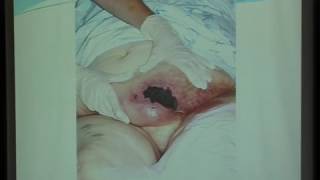 UNC VIDEOS calcified Uremic Arteriolopathy Calciphylaxis Dr Mohamed Sobh [upl. by Anhej895]