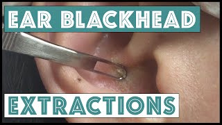 Ear Extractions [upl. by Yerocal]