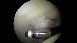 Articular Cartilage with a Grade 3 Injury to the Posterior Acetabulum near full thickness [upl. by Nwad102]