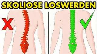 Wie man Skoliose auf natürliche Weise in 5 Minuten am Tag beheben kann [upl. by Collins617]
