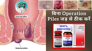 homeopathic medicine for piles piles without pain burning bleeding  piles cure without operation [upl. by Arda]