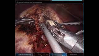 ROBOTIC ANATOMICAL RIGHT HEPATECTOMY AND DISTAL PANCREATECTOMY FOR OLIGOMETASTATIC PANCREAS ADENOCAR [upl. by Gnouv]