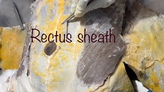 Rectus Sheath  dissection [upl. by Atinihc9]