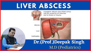 liver abscess  Hepatic abscess  Amoebic abscess  Deepak PD Singh [upl. by Irol]