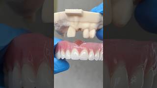 Before and After Immediate Denture ​⁠EnvisiontecMain envisiontec lsk121shorts dentist [upl. by Ilan]