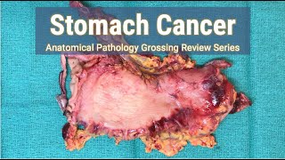 Stomach Cancer  Anatomical Pathology Grossing Review Series [upl. by Adihsaar]