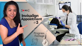 Invisalign Appointment 3 Progress Footage [upl. by Mano]