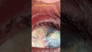 Corneal opacity after keratoplasty [upl. by Kendell]